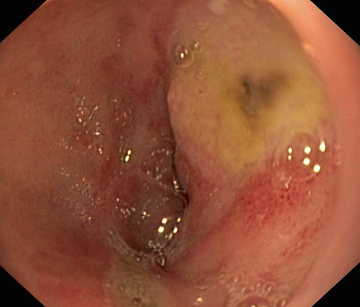 EndoCollab™ | GI Endoscopy Community tweet media