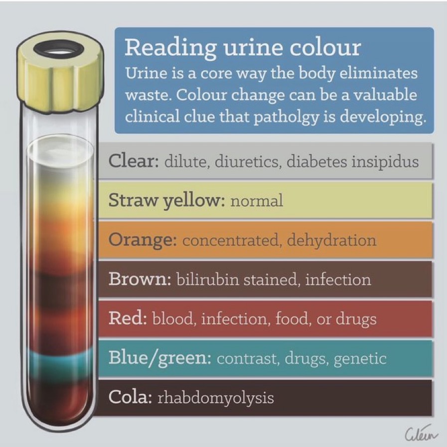 Dilute Urine Color dilute-urine-color