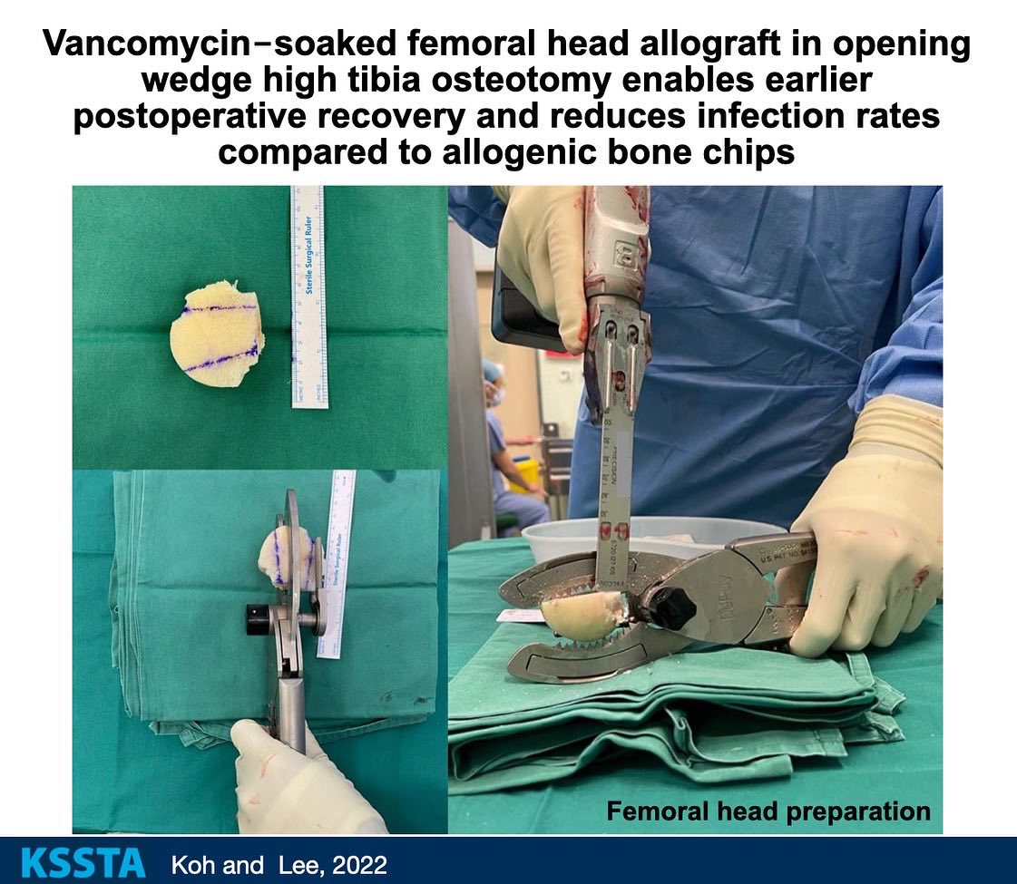 KSSTA's tweet photo. Vancomycin soaked femoral head allograft promotes early postoperative recovery and reduces infection rates in opening wedge high tibia osteotomy.

#hightibialosteotomy #varusdeformity #allograft #osteoarthritis #gonarthrosis

Link: https://t.co/tse7HtB1Iw https://t.co/GUF0rRUrxz