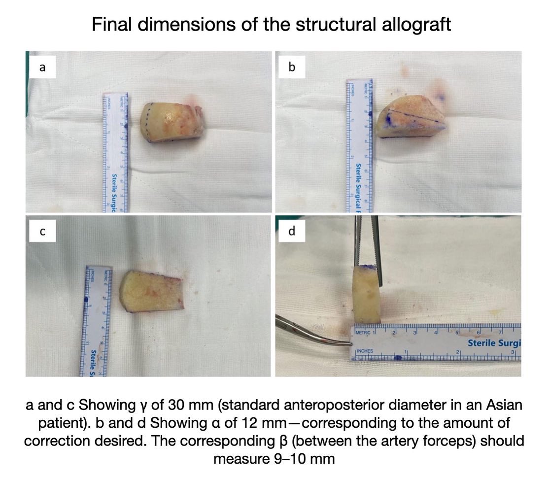 KSSTA's tweet photo. Vancomycin soaked femoral head allograft promotes early postoperative recovery and reduces infection rates in opening wedge high tibia osteotomy.

#hightibialosteotomy #varusdeformity #allograft #osteoarthritis #gonarthrosis

Link: https://t.co/tse7HtB1Iw https://t.co/GUF0rRUrxz
