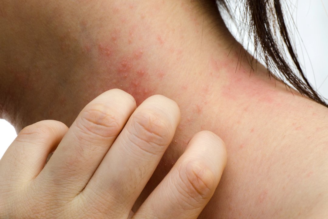 To reduce #atopicdermatitis flares as patients transition to #JAKinhibitors, authors of a @DermatitisJrnl article propose a tapering schedule for patients on immunosuppressants or dupilumab. #DermWorldWeekly - bit.ly/3FAVKlO