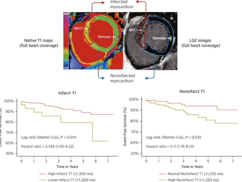 Interested in the prognostic role of noninfarcted myocardium in STEMI patients? Read the last paper from the @OxAMI_Study led by @MayooranShan @AmbraMasi and Thank you for including me @dterentes @DrMattBurrage @RafKotronias @GiovanniLuigiD1