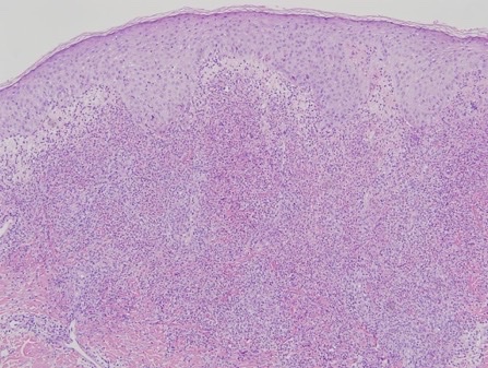 A 32-year-old female awoke with profound blurriness in the right eye. She has also constant joint aches, frequent headaches, neck pain. She also noted recurrent oral ulcers &amp; a recent genital ulcer. What is the likely diagnosis? #Medtwitter (Image: derm advisor)
