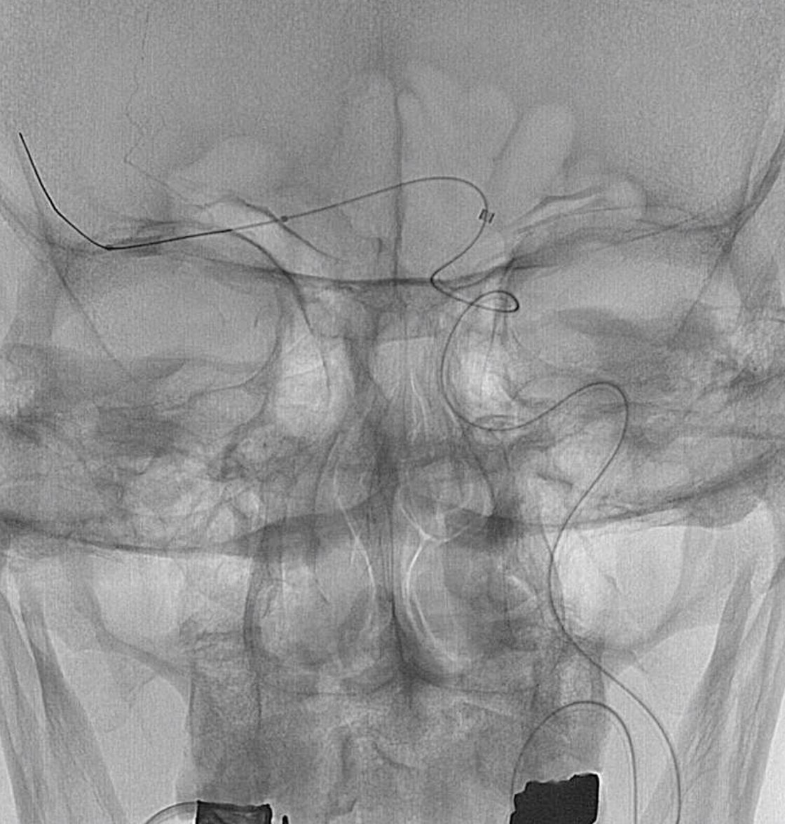 First robotic-assisted intracranial implant of Cerus Endovascular contour  intrasaccular device - NeuroNews International