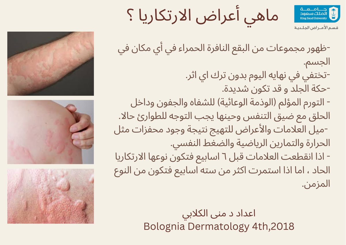 DERMA_KSU's tweet photo. تعد الارتكاريا ( الشرى ) من الحالات المنتشرة في المجتمع . يصاحبها ظهور تورم متعدد الاحجام والاشكال وشديد الحكة على الجلد. دعونا نتعرف اكثر على اعراض الارتكاريا . #الامراض_الجلدية #الارتكاريا #حكة #حساسية #امراض_الجلد #الشرى #الوذمة_الوعائية #urticaria https://t.co/4zj6vbDs9k