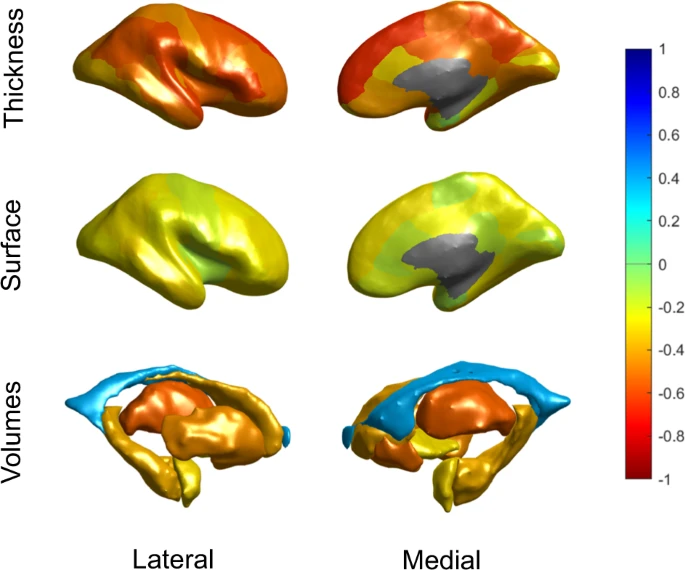 molpsychiatry's tweet photo. Brain ageing in schizophrenia: evidence from 26 international cohorts via the ENIGMA Schizophrenia consortium. By Constantinos Constantinides et al. @BathPsychology @UniMelb #schizophrenia #brainageing #cognitiveimpairment #psychiatry #OpenAccess https://t.co/MMQdHO5lSg https://t.co/jlYU8Cq8KB