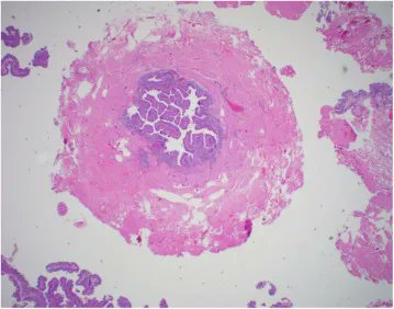 European Urology Oncology (@eururoloncol) on Twitter photo Editor's Choice: Best Practices to Optimise Quality and Outcomes of Transurethral Resection of Bladder Tumours
euoncology.europeanurology.com/article/S2588-…
<a href="/ahmostafid/">Hugh Mostafid</a> <a href="/UroDocAsh/">Ashish M. Kamat, MD, MBBS</a> <a href="/siadaneshmand/">Sia Daneshmand, M.D.</a> <a href="/joanfundi/">Joan Palou Redorta</a> <a href="/JamesJmm23/">james mckiernan</a> <a href="/JimCatto/">jim catto</a>
#Editorschoice #bladder #UroOnco Editor's Choice: Best Practices to Optimise Quality and Outcomes of Transurethral Resection of Bladder Tumours
euoncology.europeanurology.com/article/S2588-…
<a href="/ahmostafid/">Hugh Mostafid</a> <a href="/UroDocAsh/">Ashish M. Kamat, MD, MBBS</a> <a href="/siadaneshmand/">Sia Daneshmand, M.D.</a> <a href="/joanfundi/">Joan Palou Redorta</a> <a href="/JamesJmm23/">james mckiernan</a> <a href="/JimCatto/">jim catto</a>
#Editorschoice #bladder #UroOnco
