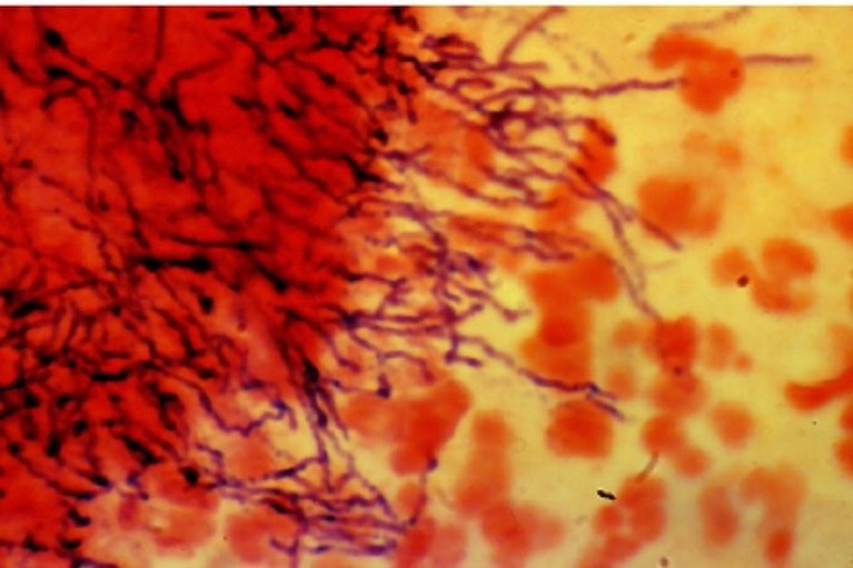 BrownJHM's tweet photo. A 40 year old diabetic p/w difficulty chewing &amp; right cheek swelling after recent dental surgery. Tissue biopsy showed branching, gram positive filaments w/sulfur granules. Acid fast test was negative. What is the diagnosis &amp; treatment? (Image: medIndia) #IDtwitter #Medtwitter https://t.co/I7ex0fqs5H