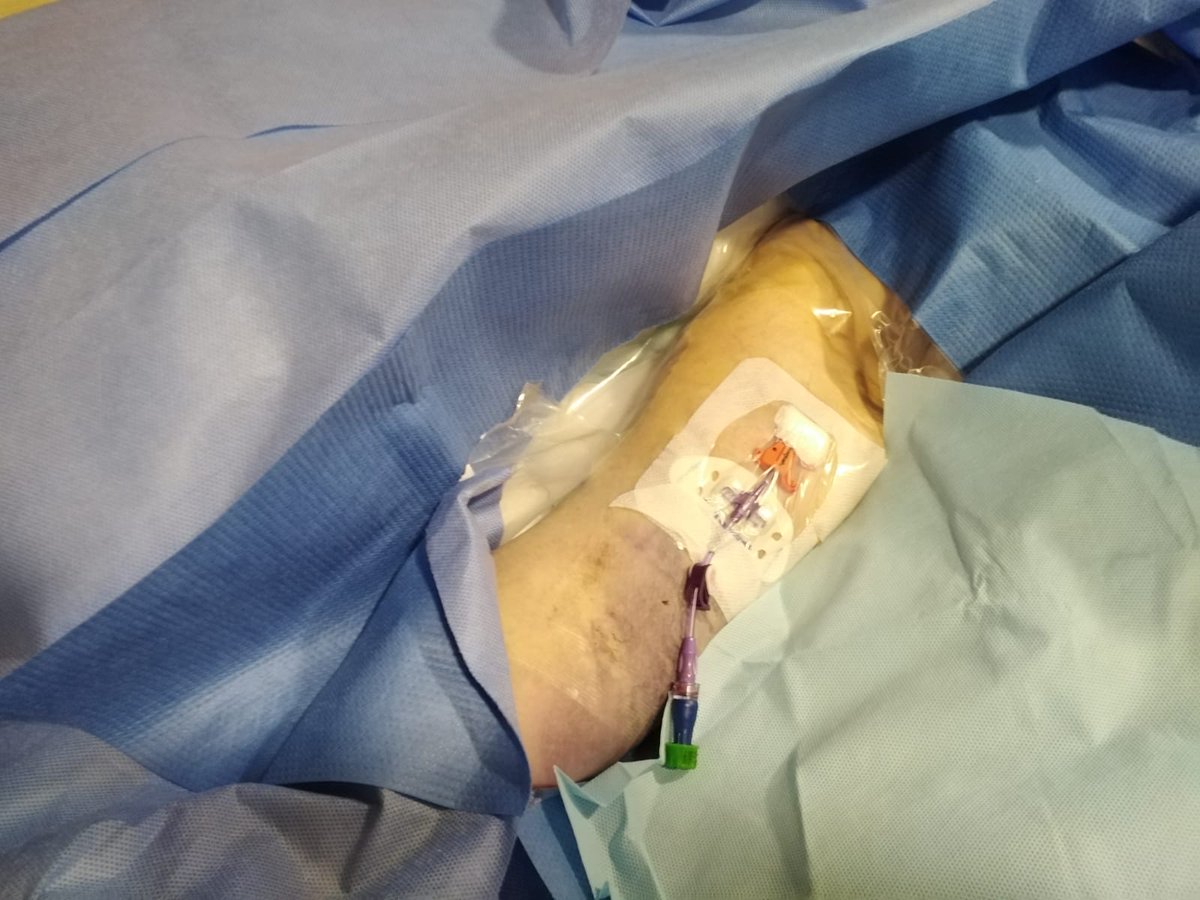 HadoChuac's tweet photo. Con conocimiento y habilidad es posible.....Cateter Picc ecoguiado en Residencia de Mayores.
Gracias Santi
@sehad https://t.co/7f6UiXQMHc