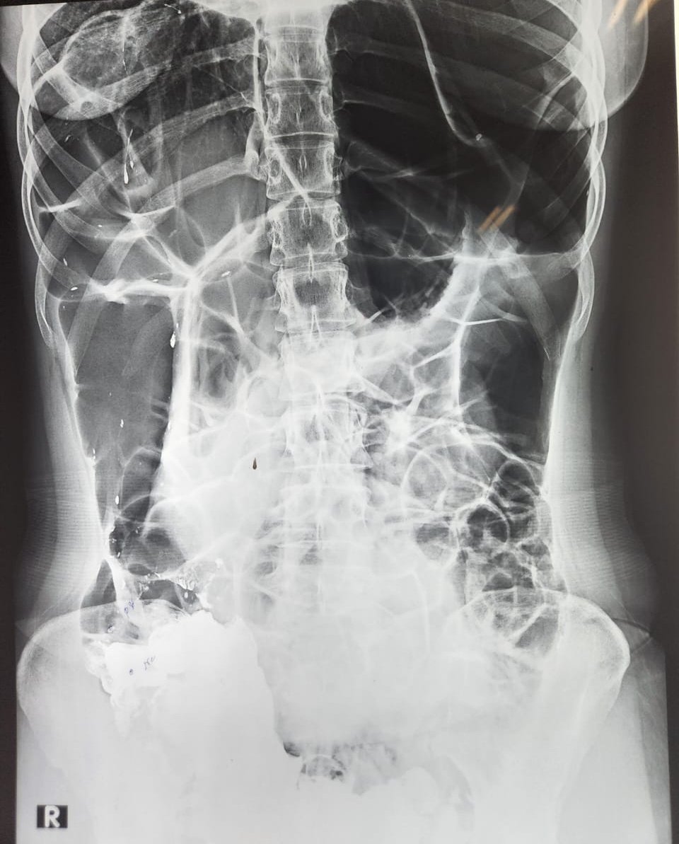 drakashmathur's tweet photo. #InterestingCase
🤯 27/F presented with bloating, early satiety for few years but increased for last 6 months
⚡ No nausea/vomiting/constipation/diarrhea
⚡ CT s/o hugely dilated stomach and bowel loops
Need inputs for D/D and management ? 🤔
#GITwitter #MedTwitter #MedEd https://t.co/fAxY2Not1U