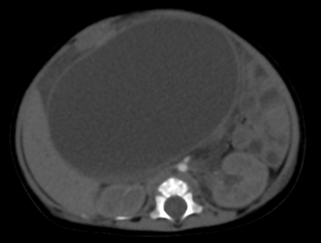 Tatisfc15's tweet photo. La palpación de abdomen debe ser parte fundamental durante la evaluación del paciente pediátrico, independientemente del motivo de consulta, aún si es por control de crecimiento y desarrollo.  
Foto: impresionante quiste de coledóco en paciente femenina de 3 meses. https://t.co/gG0cu4nIlM