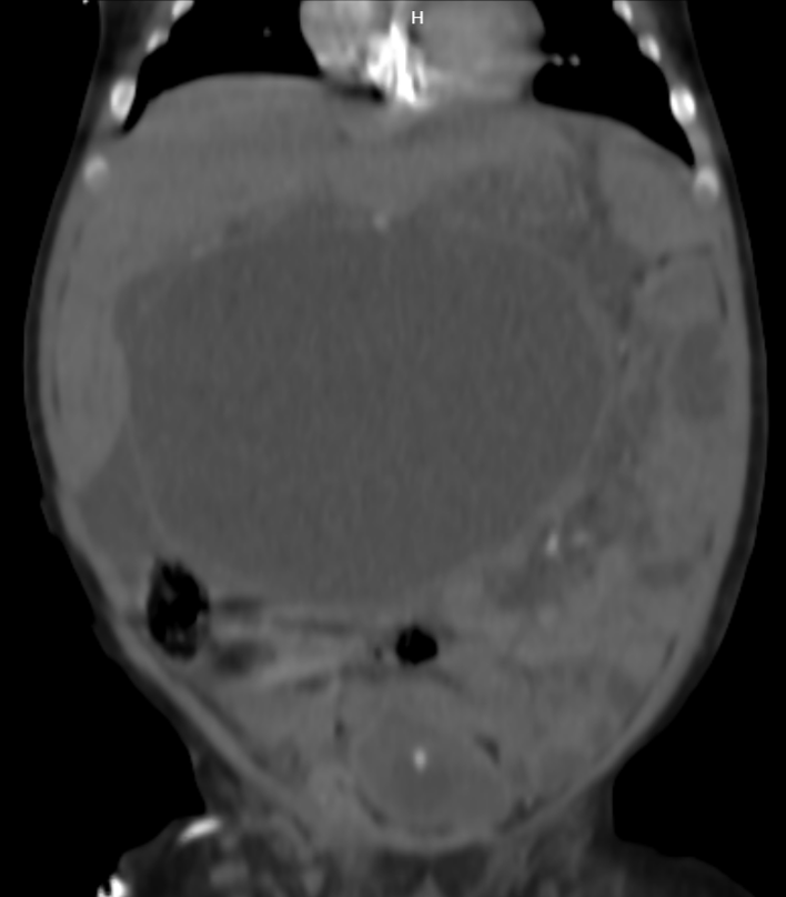 Tatisfc15's tweet photo. La palpación de abdomen debe ser parte fundamental durante la evaluación del paciente pediátrico, independientemente del motivo de consulta, aún si es por control de crecimiento y desarrollo.  
Foto: impresionante quiste de coledóco en paciente femenina de 3 meses. https://t.co/gG0cu4nIlM