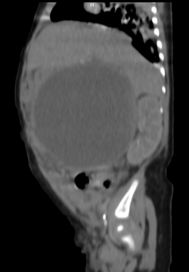 Tatisfc15's tweet photo. La palpación de abdomen debe ser parte fundamental durante la evaluación del paciente pediátrico, independientemente del motivo de consulta, aún si es por control de crecimiento y desarrollo.  
Foto: impresionante quiste de coledóco en paciente femenina de 3 meses. https://t.co/gG0cu4nIlM
