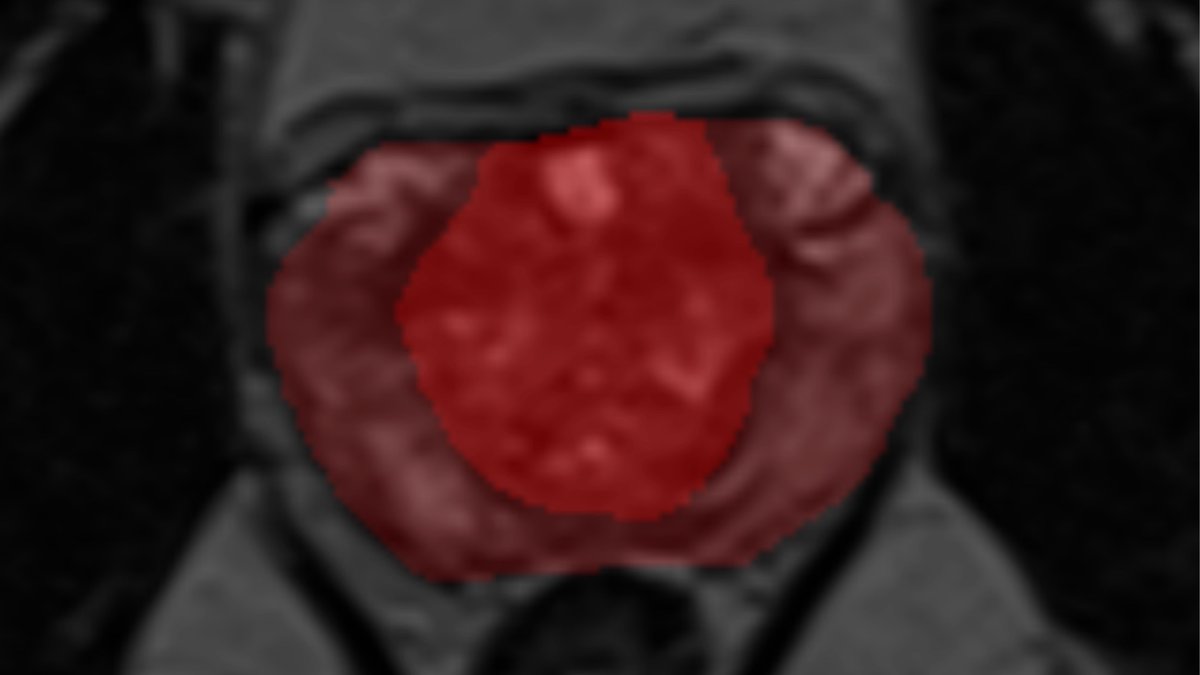 Bernoulli_Lab (@bernoulli_lab) on Twitter photo Découvrez le projet PAIMRI, soutenu par <a href="/Bernoulli_Lab/">Bernoulli_Lab</a>, et qui vise à développer un algorithme d’IA pour l’interprétation de l’IRM de la prostate. bernoulli-lab.fr/project/paimri/ Découvrez le projet PAIMRI, soutenu par <a href="/Bernoulli_Lab/">Bernoulli_Lab</a>, et qui vise à développer un algorithme d’IA pour l’interprétation de l’IRM de la prostate. bernoulli-lab.fr/project/paimri/