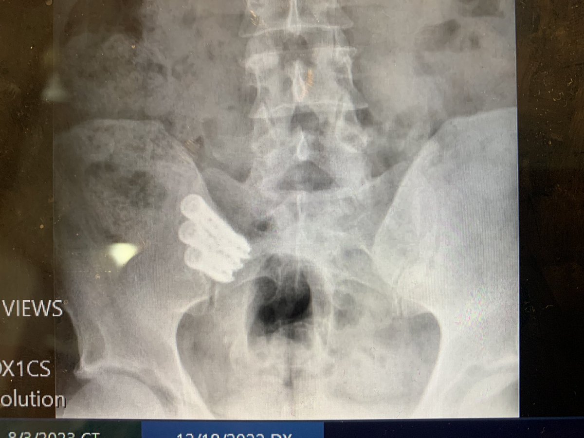 I started SI joint fusions 1 year ago and have become a firm believer. This patient I saw today and has had a 90% improvement in his preop pain. @CNS_Update @spinesection @EmoryMidtown @emoryhealthcare