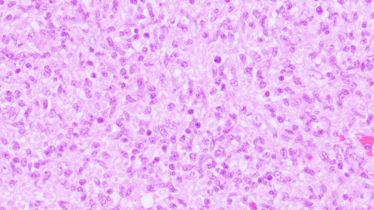 An infant presented w/an intra-axial frontal lobe lesion. A craniotomy for total resection was performed, and H&amp;E of the brain lesion showed the following. What is your differential diagnosis? What stains would you get? #BWHPathCotW #BWHNeuroPathWinter

1/