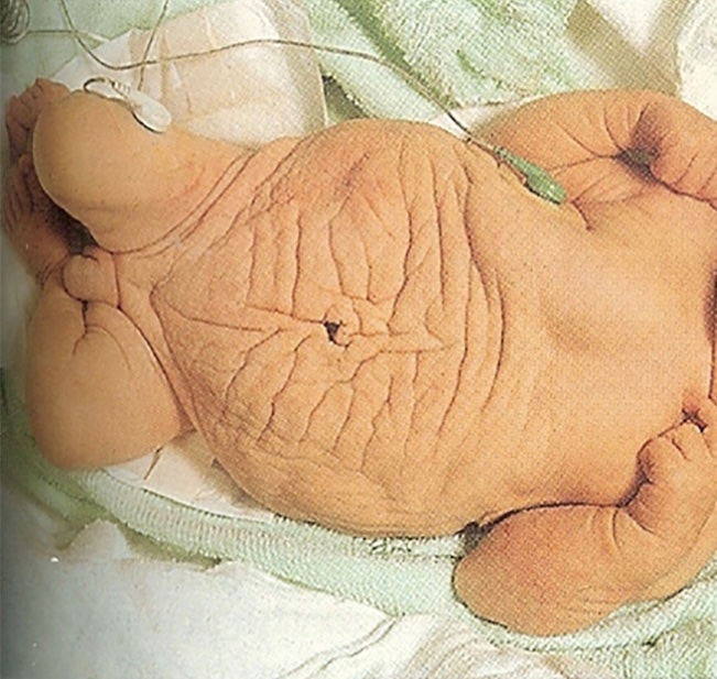 A newborn infant was noted to have wrinkled appearance of the abdomen. Exam w/palpable masses in the inguinal area. What is the likely diagnosis? (Image: Storm Anaesthesia) #Medtwitter