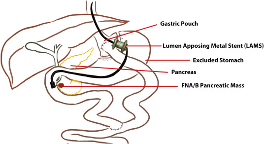 GIE (@gie_journal) on Twitter photo Listen to the podcast of "EUS-directed transgastric interventions in Roux-en-Y gastric bypass anatomy: a multicenter experience" by Ghandour et al. giejournal.org/content/podcast Listen to the podcast of "EUS-directed transgastric interventions in Roux-en-Y gastric bypass anatomy: a multicenter experience" by Ghandour et al. giejournal.org/content/podcast