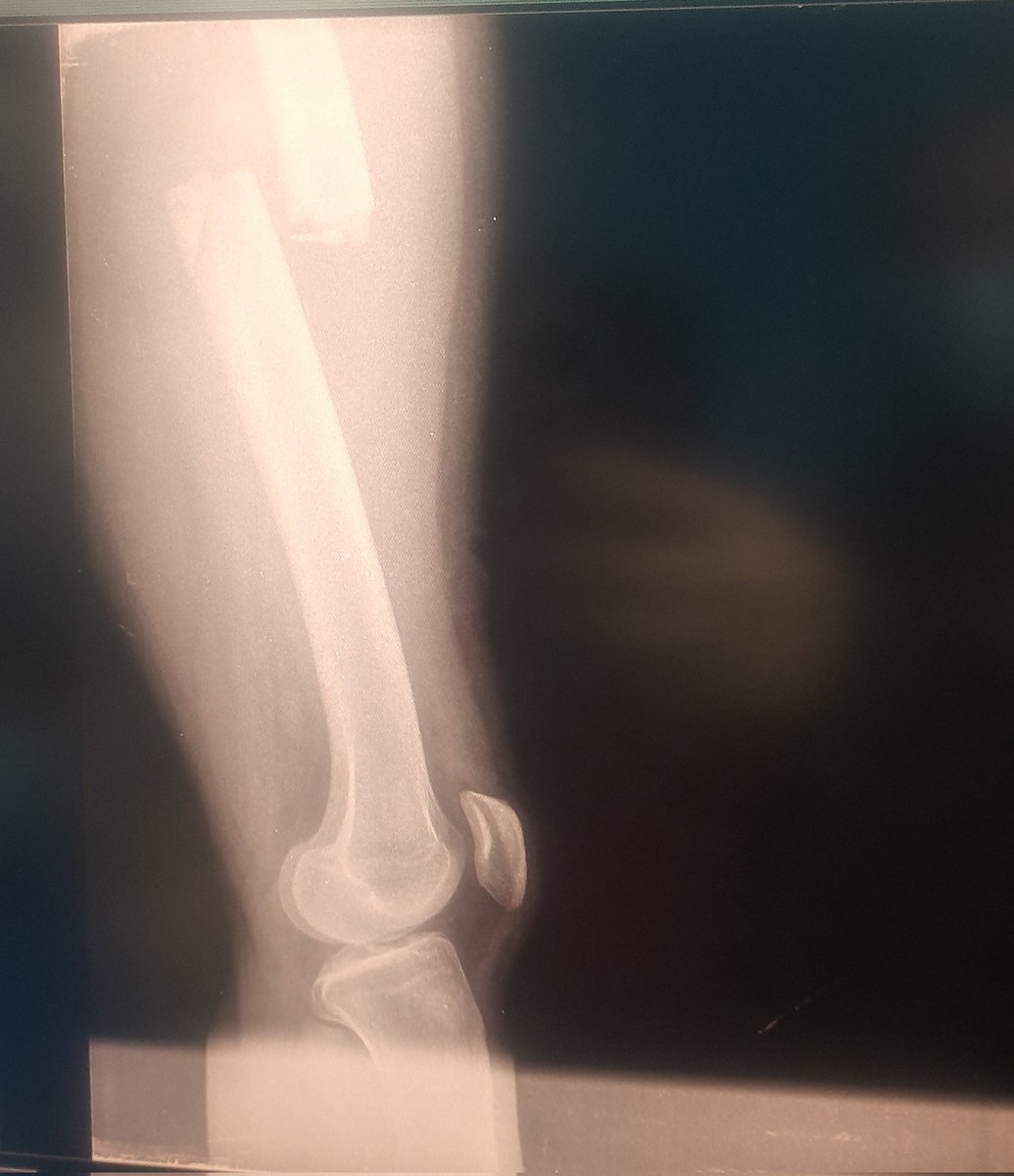 Dramariacorona's tweet photo. No tomen y manejen moto por favor! este paciente 18 añitos y esto es solo una fractura, tiene fractura frontal y contusiones, Diciembre es para disfrutar en familia, no para beber hasta morir 🙄 https://t.co/hPozq6xt7d