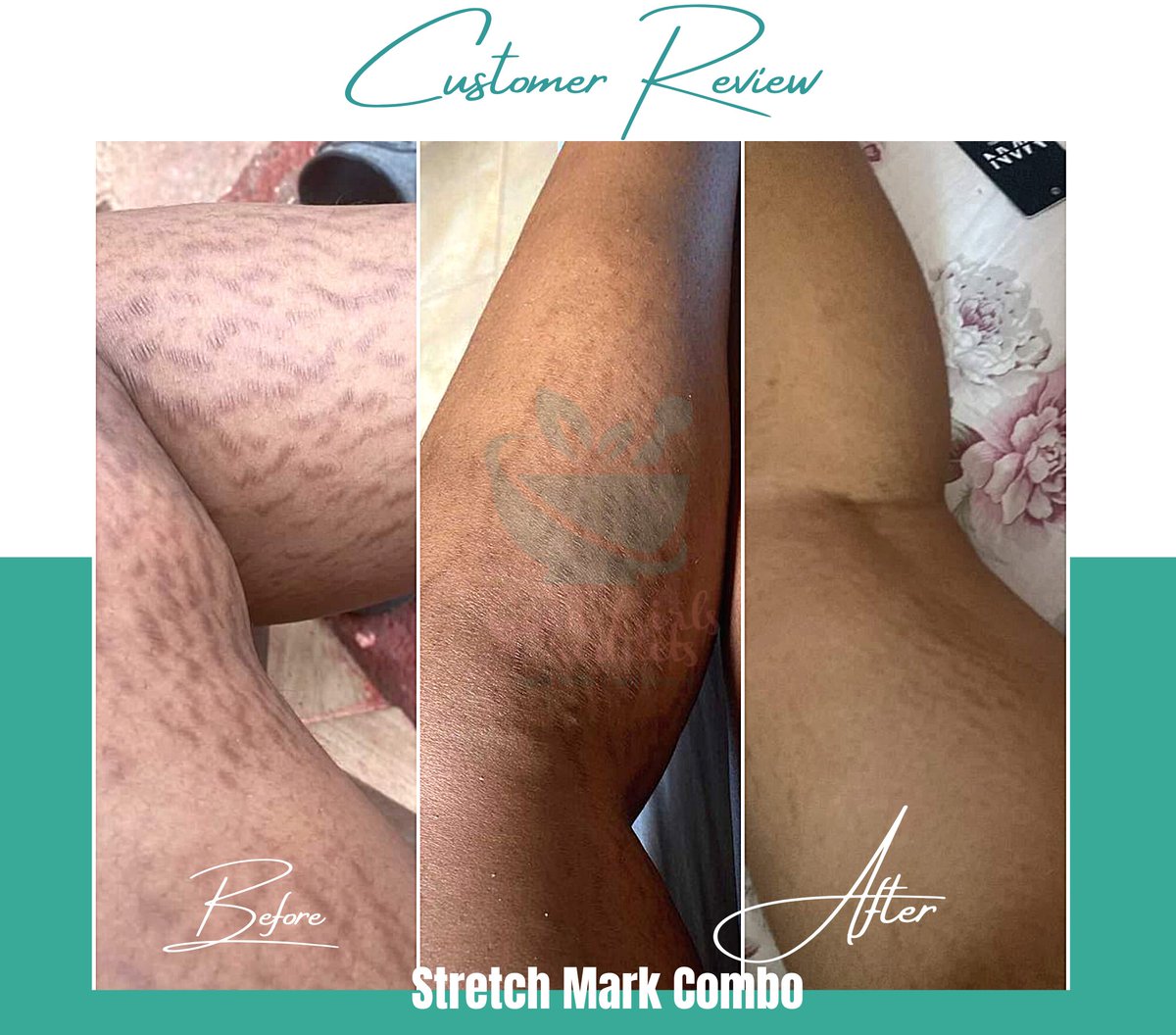SavingSkinInJA's tweet photo. Tired of Stretch Marks? Shop At Good Girls Products for products that actually work. 
Visit out website at https://t.co/18oSoNUIh5
#Jamaica #jamaicanskincare #jahjah #stretchmark #stretchmarksolution #stretchmarkremover https://t.co/6g2VVyAkYG