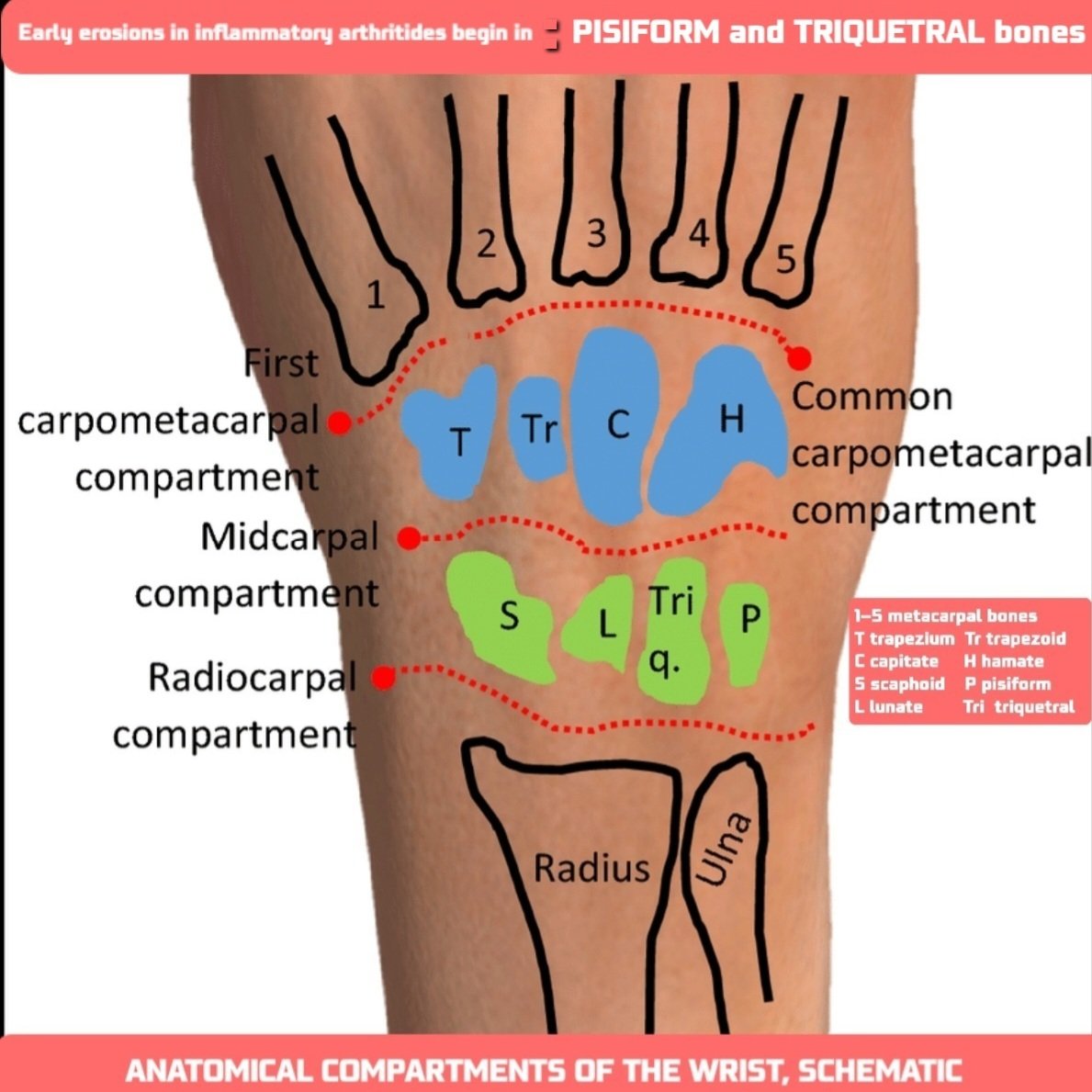 On Twitter In Rheumatoid Arthritis Ra Conventional Radiography Cr Of