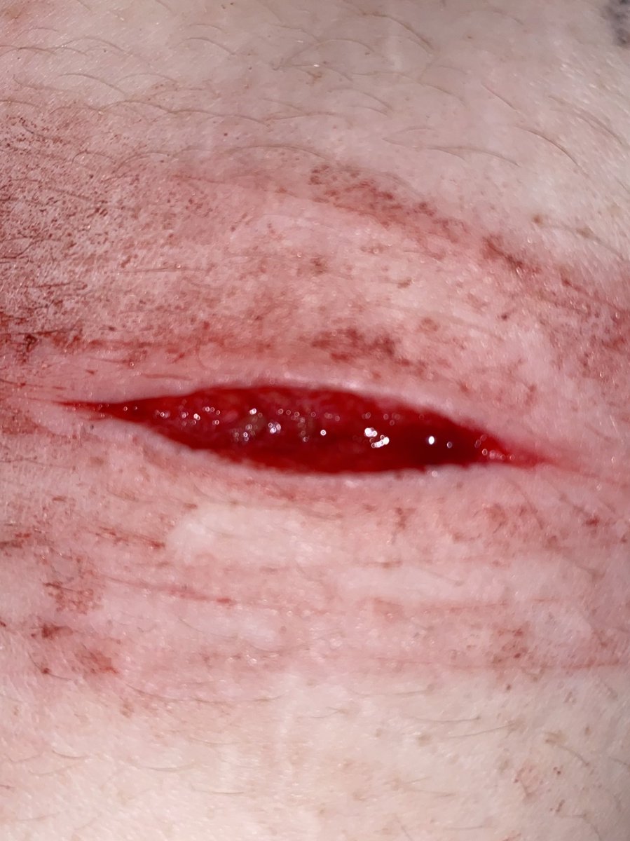 bensbladez's tweet photo. Baby beans from last night 

TW SH IMAGES 

ALL FAKE TWITTER THIS IS SFX MAKEUP

Beanstwt shtwt 5htwt $htwt $h sh babybeans baby beanstwt styrotwt catscratchtwt https://t.co/mxXg312hYm