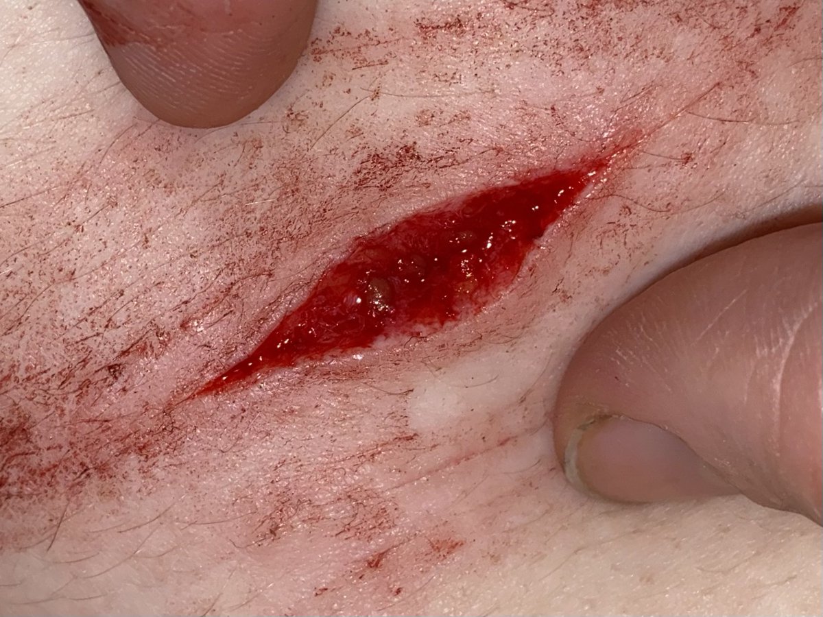bensbladez's tweet photo. Baby beans from last night 

TW SH IMAGES 

ALL FAKE TWITTER THIS IS SFX MAKEUP

Beanstwt shtwt 5htwt $htwt $h sh babybeans baby beanstwt styrotwt catscratchtwt https://t.co/mxXg312hYm