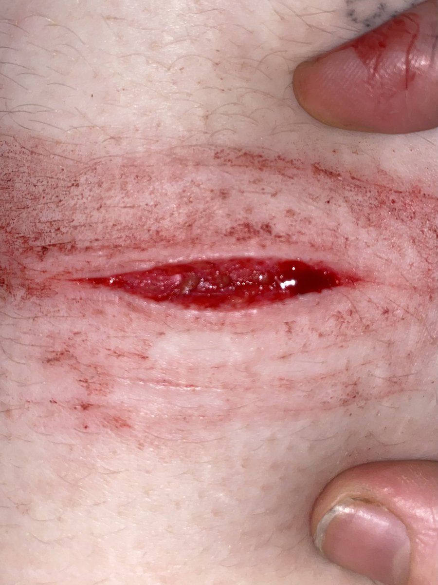 bensbladez's tweet photo. Baby beans from last night 

TW SH IMAGES 

ALL FAKE TWITTER THIS IS SFX MAKEUP

Beanstwt shtwt 5htwt $htwt $h sh babybeans baby beanstwt styrotwt catscratchtwt https://t.co/mxXg312hYm
