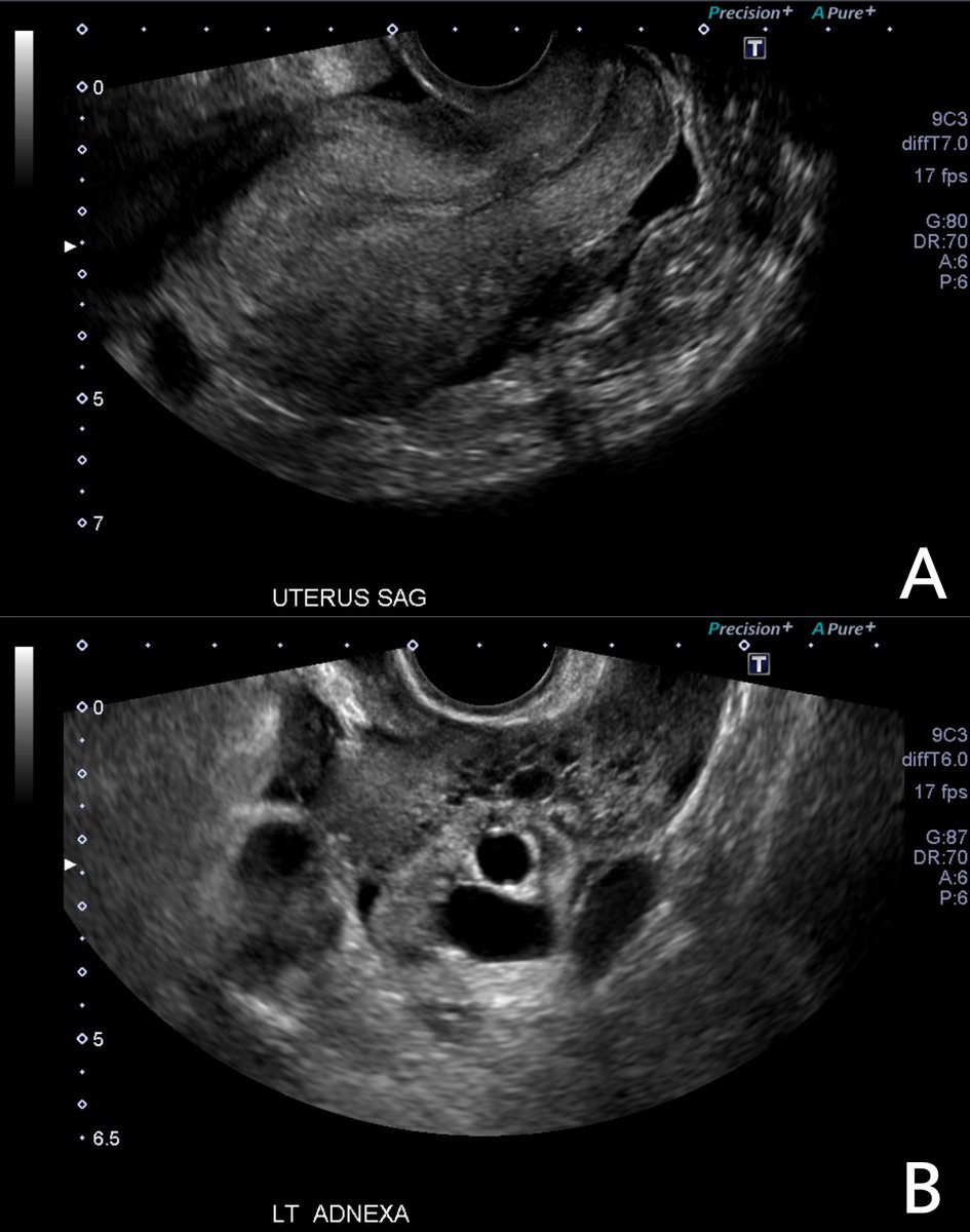MathewLeonardi's tweet photo. A Rare Case of a Twin Tubal Stump Pregnancy Postunilateral Salpingectomy!

Woah! 😮

Such a cool case that the @McMasterOBGYN team published some awesome images and the story in @AAGLJMIG (w consent)

Check out more details (free access x 50 days) ⬇️
 https://t.co/26u2tOorWD https://t.co/tZFB4SfEd0