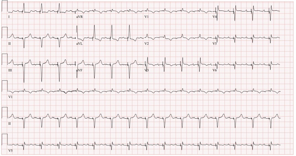 Patient came in with initial ECG. Placed DC pacemaker w #LBBpacing and got called by nurse later that “pacemaker is not pacing” (ECG#2). Fortunately an easy programming change fixed the problem (ECG#3). I’ve seen this before w #Conductionsystempacing 

#EPeeps #dontdisthehis