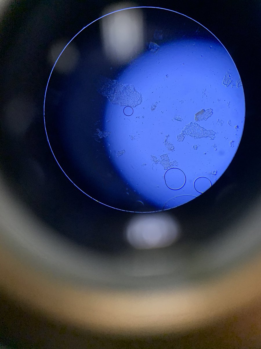 viral_nephro's tweet photo. @askrenal Renal Community Please help with this crystals https://t.co/12nGuqCq73