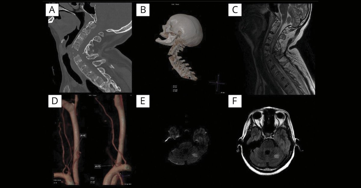 #NeuroImage: Spinal Cord Injury, Vertebral Artery Dissection, and Cerebellar Strokes After Chiropractic Manipulation 

Learn more: bit.ly/3H16gDI 
#NeuroTwitter #Neurology
