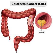 Colon cancer is sometimes called colorectal cancer, which is a term that combines colon cancer and rectal cancer, which begins in the rectum.
#coloncancer #rectalcancer #colorectalcancer #polyps #endocrinology