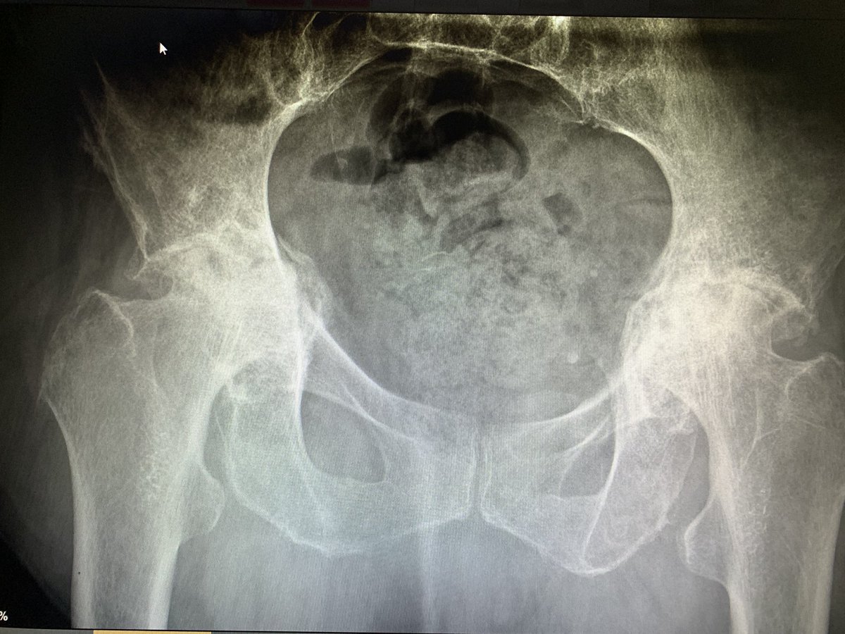 Nein, liebe Kollegen ich werde die Knie nicht operieren.
Ich weiß, dass wir alle viel zu tun haben, aber wenn man ein 1/2y die Knie „behandelt“ und es nicht besser wird, dann könnte das Problem auch woanders liegen. 
Patientin mit beidseitiger Hüftkopfnekrose und Protrusion.