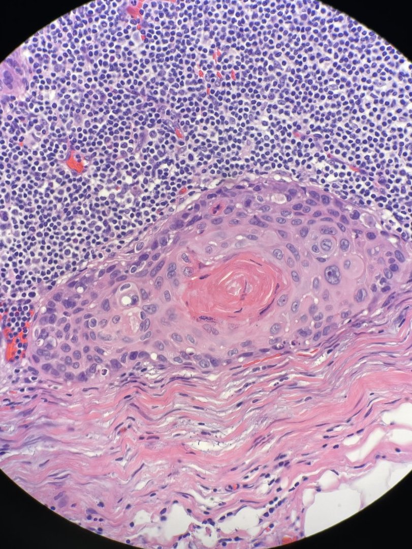 megothelioma's tweet photo. We're always checking the subcapsular sinus of lymph nodes as a prime location for metastases. This is a nice example of a squamous cell carcinoma metastasizing to that area. #PathTwitter #BasicPath https://t.co/7gxi3gXHVW