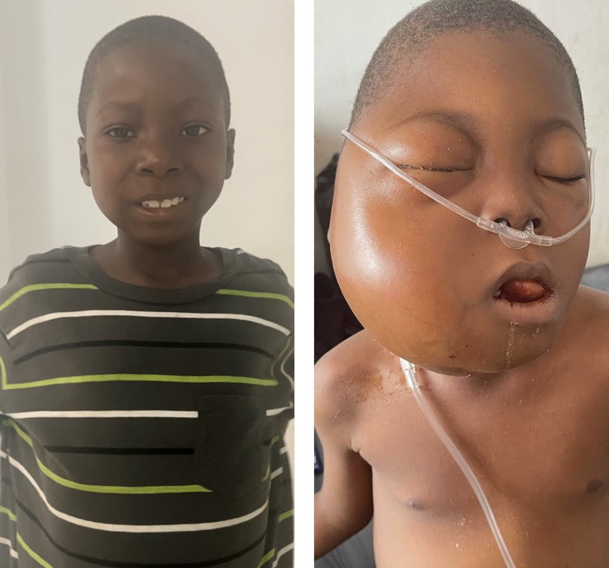 At the <a href="/HealingLiberia/">Healing Liberia Foundation</a> we save lives! Meet Joseph Hena from Lofa County. On September 21st, 2021 we came in contact with Joseph while he was fighting for his life. He was quickly diagnosed with stage 3 cancer and started chemotherapy almost immediately because…