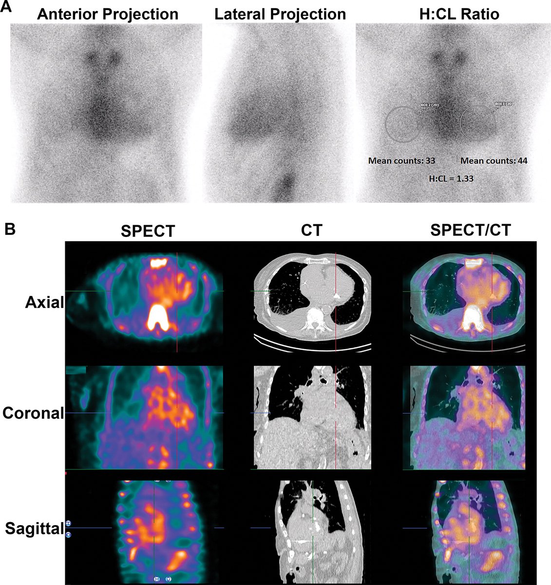 Radiology (@radiology_rsna) on Twitter photo In patients with heart failure and features of infiltrative heart disease, myocardial uptake at 99mTc-PYP/DPD/HMDP imaging is nearly 100% specific for transthyretin cardiac amyloidosis. <a href="/DorbalaSharmila/">Sharmila Dorbala</a> @SarahCud @Rodney_Falk <a href="/BWHAmyloid/">BWH Amyloidosis Program</a> <a href="/SinghVasvi/">Vasvi Singh</a> bit.ly/3jkssiv In patients with heart failure and features of infiltrative heart disease, myocardial uptake at 99mTc-PYP/DPD/HMDP imaging is nearly 100% specific for transthyretin cardiac amyloidosis. <a href="/DorbalaSharmila/">Sharmila Dorbala</a> @SarahCud @Rodney_Falk <a href="/BWHAmyloid/">BWH Amyloidosis Program</a> <a href="/SinghVasvi/">Vasvi Singh</a> bit.ly/3jkssiv