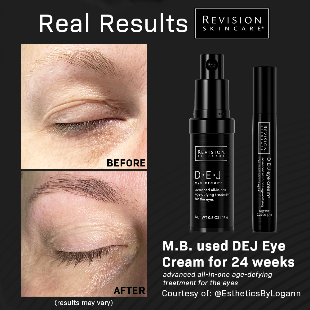 MariettaPlastic's tweet photo. Now through 1/2, spend $125 on Revision Skincare and receive a FREE trial size of DEJ Eye Cream!

Revision DEJ Eye Cream is clinically proven to reduce signs of aging around the total eye area including eyelid drooping, fine lines, and more.

Shop here: ⤵️
https://t.co/FcD8SLfdyY https://t.co/DfrN0W0KwU