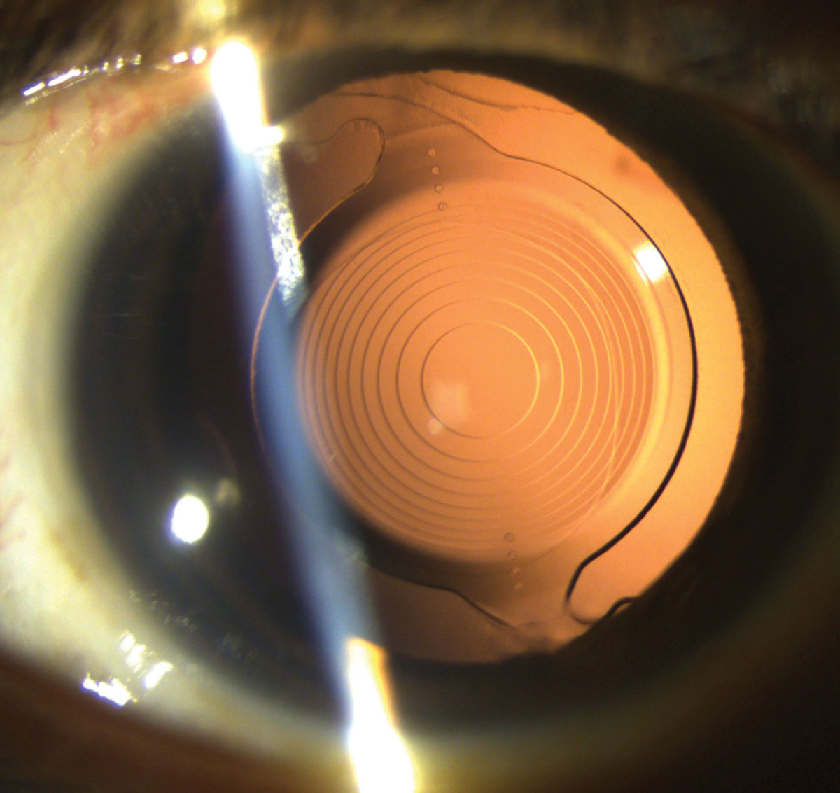 revoptom's tweet photo. Our #RO2022inreview series includes the #ROtop30 news stories. Here’s No. 20.
Researchers found that mask wear can change the axis of astigmatism, complicating toric IOL calculations and outcomes. 😷
https://t.co/6Gk2F6V9IM
#astigmatism #maskwear #eyecare https://t.co/WlwNT47GvI