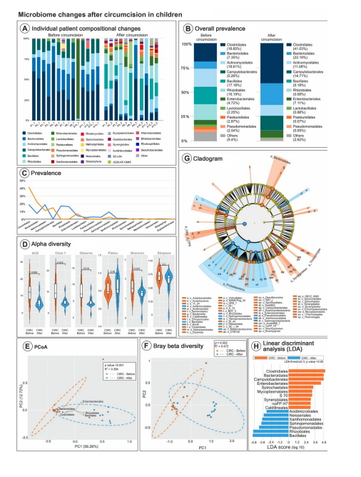 Circumcision is controversial. Hope for this to lay the groundwork for non-HPV #penilecancer &amp; role of #microbiome  Our @scientistatlrge 3rd pub! 
- Decrease in sulfur reducing bacteria(H2S)/anaerobes post circ. Thiosulfate is an appealing link to study authors.elsevier.com/a/1gIK%7E8Yy0L…