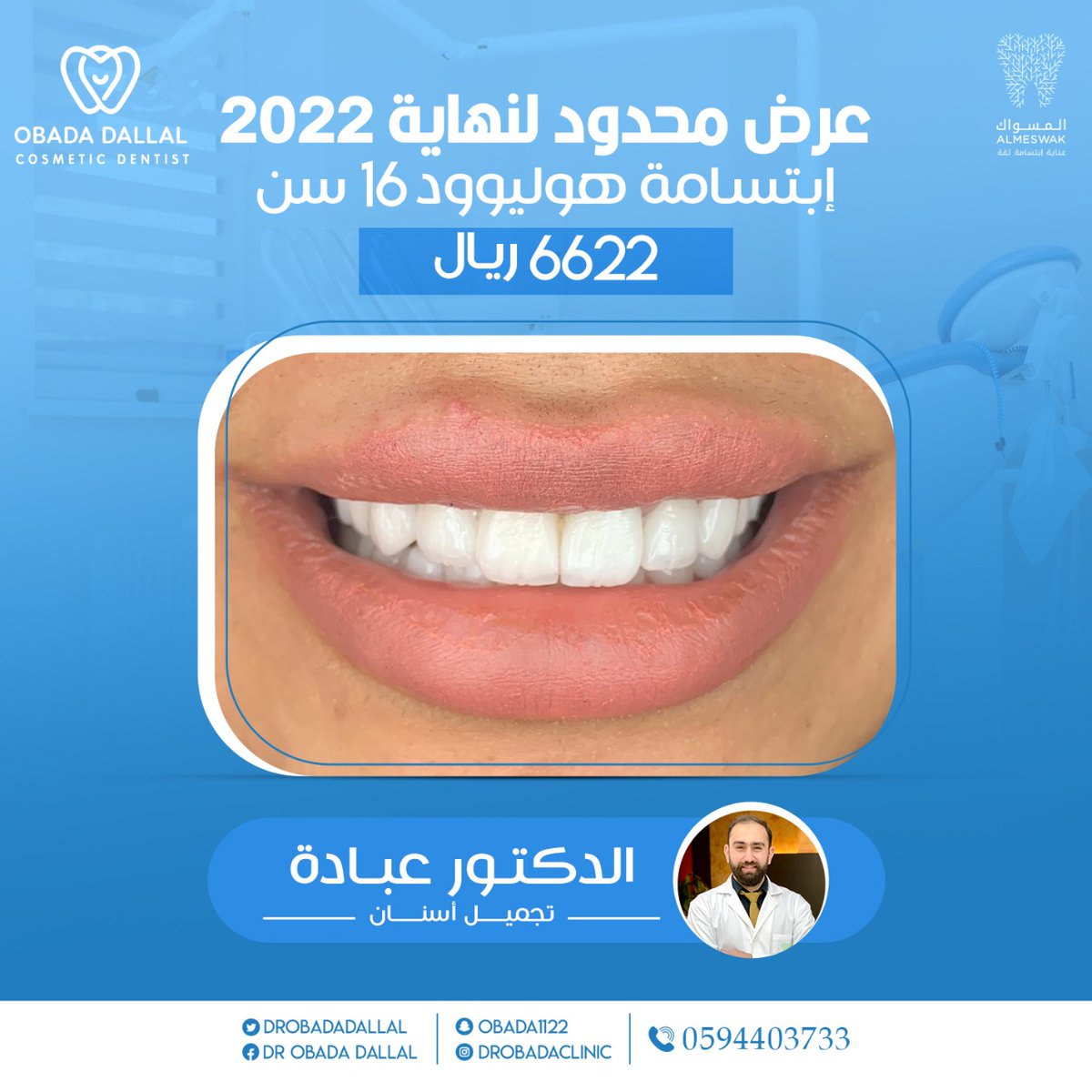 العمر مره وحده 😍 لا يفوتكم مع الدكتور المبدع / عبادة دلال 
 إبتسامة هوليوود 16 سن يبدأ 6622 ريال شامل
وبيكون مستمر حتى نهاية 2022
 العلاجات + كوبون هدية 🎟

في عيادات المسواك VIP - الرياض 
رقم الحجز والاستفسارات:
(  0594403733 )

#عباده_دلال #دكتور_عباده #المسواك_لطب_الأسنان