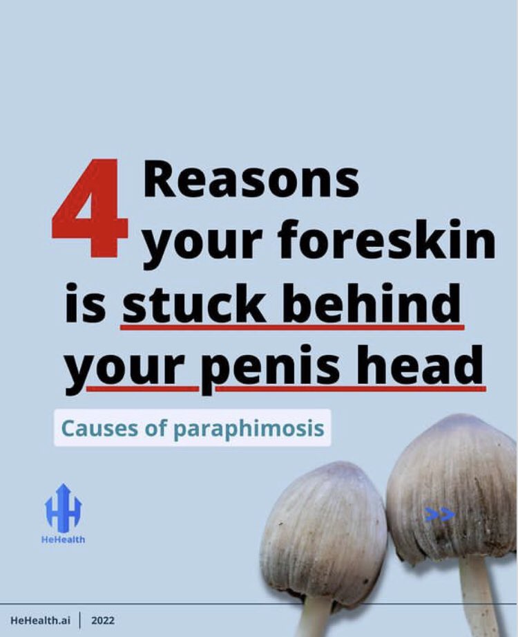 HeHealthai's tweet photo. Paraphimosis is a penile condition that causes the foreskin to get stuck around the head of the penis when pulled back, and it’s an emergency condition that needs immediate attention.
#menshealth #HeHealth #awareness #sexualhealth #phimosis #genitalhealth #healthylifestyle https://t.co/rUt3i9J7wQ