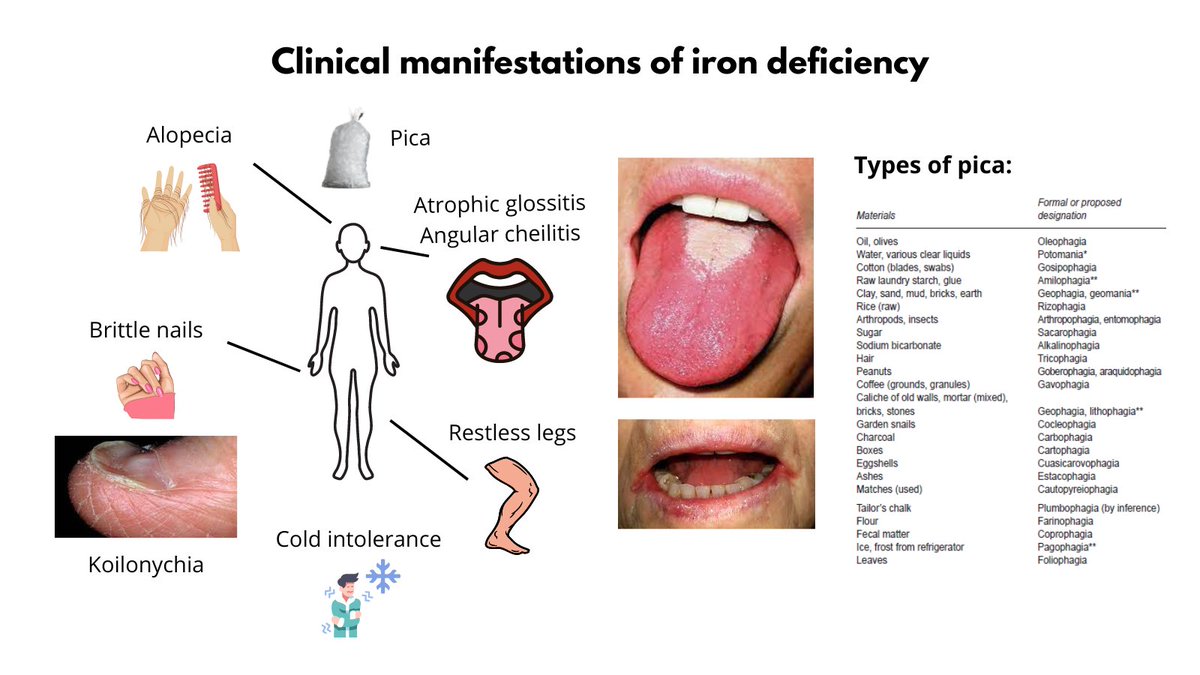 Iron Deficiency Symbol Stock Illustrations – 123 Iron Deficiency Symbol  Stock Illustrations, Vectors & Clipart - Dreamstime
