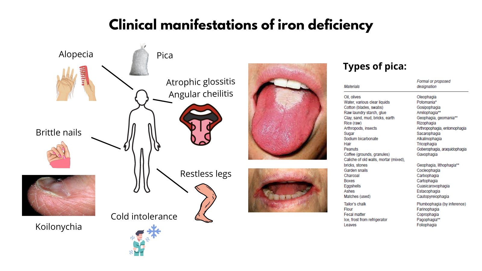 Iron Deficiency Anemia Tongue