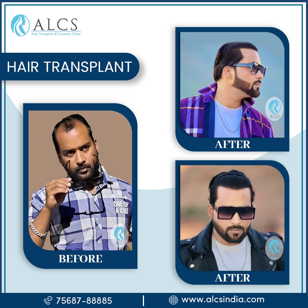 AlcsJaipur's tweet image. Before &amp;amp; After .🧑‍⚕️🤍

Visit ALCS for the best Hair Transplant experience.👌💫👨‍⚕️💈

☎️Call us on 7568788885 for an Appointment