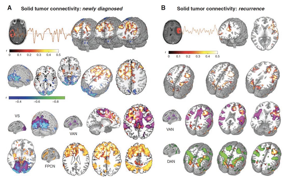 Our #braintumor #fMRI paper is out in @EditorNeuro: we found Tumor Functional #Connectivity in #glioma that also predicts #survival! #CancerNeuroscience #neuroscience @NeuroOnc @PNNResearch @ESantarnecchi @GolbyLab @simonerossi60 @TYM2004 @paxyjuvekar academic.oup.com/noa/article/4/…