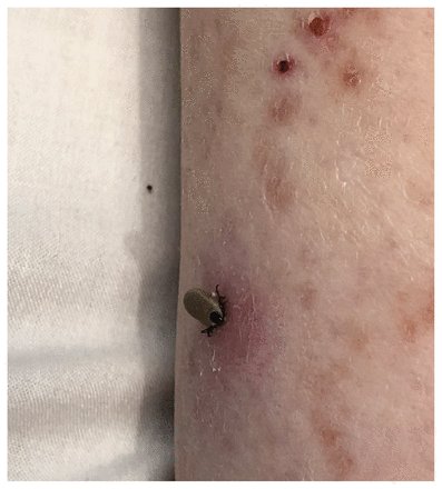 Andreas Laupacis (@andreaslaupacis) on Twitter photo A patient presents with 3(!!!) different infections from a tick bite at the same time. Although still rare, multiple infections are increasing. Always examine the skin cmaj.ca/content/cmaj/1β¦ <a href="/RoyKhalifeMD/">Roy Khalife</a> <a href="/danyalladha/">Danyal Ladha</a> @bogochisaac A patient presents with 3(!!!) different infections from a tick bite at the same time. Although still rare, multiple infections are increasing. Always examine the skin cmaj.ca/content/cmaj/1β¦ <a href="/RoyKhalifeMD/">Roy Khalife</a> <a href="/danyalladha/">Danyal Ladha</a> @bogochisaac