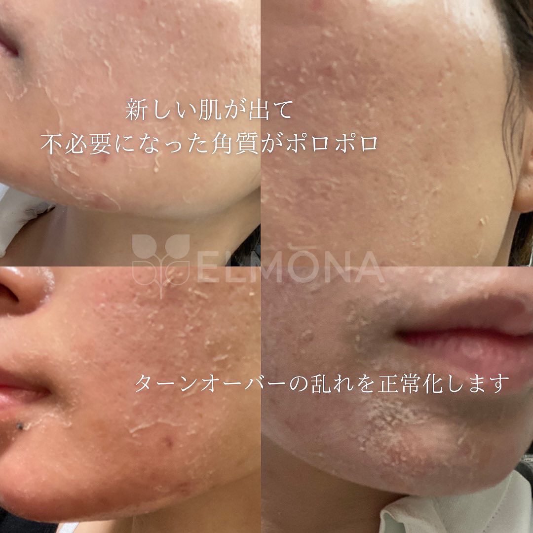 ハーブピーリング グリンピール 松戸newオープン