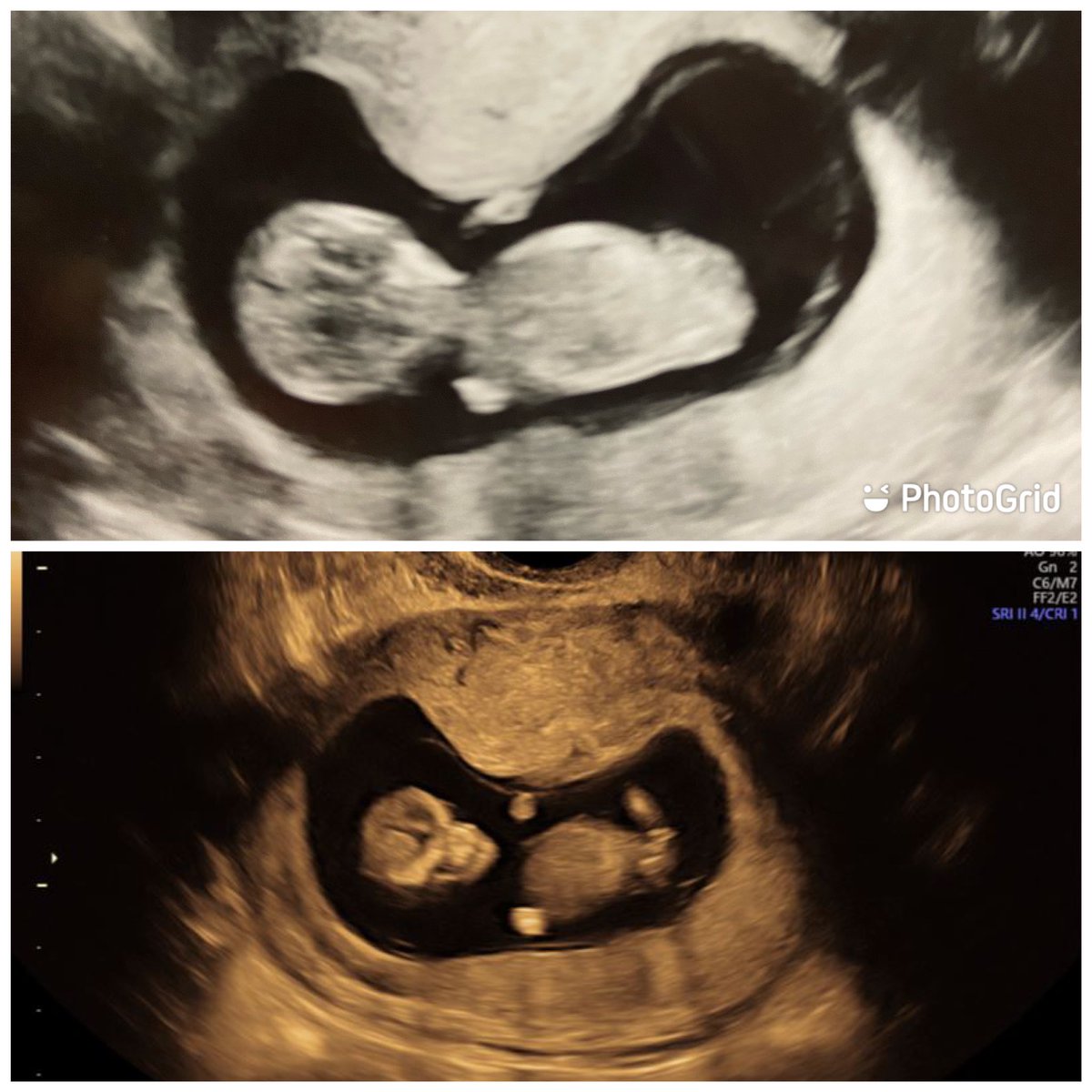 All is well with the baby as of today’s appointment. Our anatomy scan is scheduled for next month. 🥰