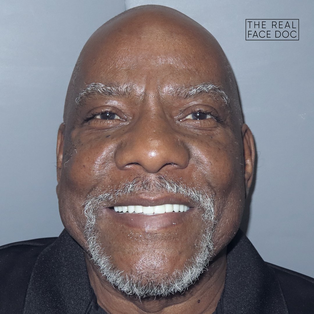 therealfacedoc's tweet photo. Morris came to us with missing teeth and a partial he had worn for years. He was looking for a more permanent, long term solution - and he ended up in the right place! Morris had two zygomatic implants placed for bone loss. Looking great! https://t.co/gwtQPPqmZZ